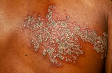 Illustration for article titled Obat Penyakit Herpes Ampuh Manjur